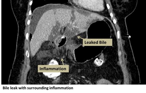 bile leakage symptoms|Bile Leak